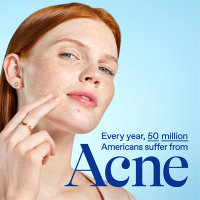 ACNE 101: KNOW YOUR ENEMY