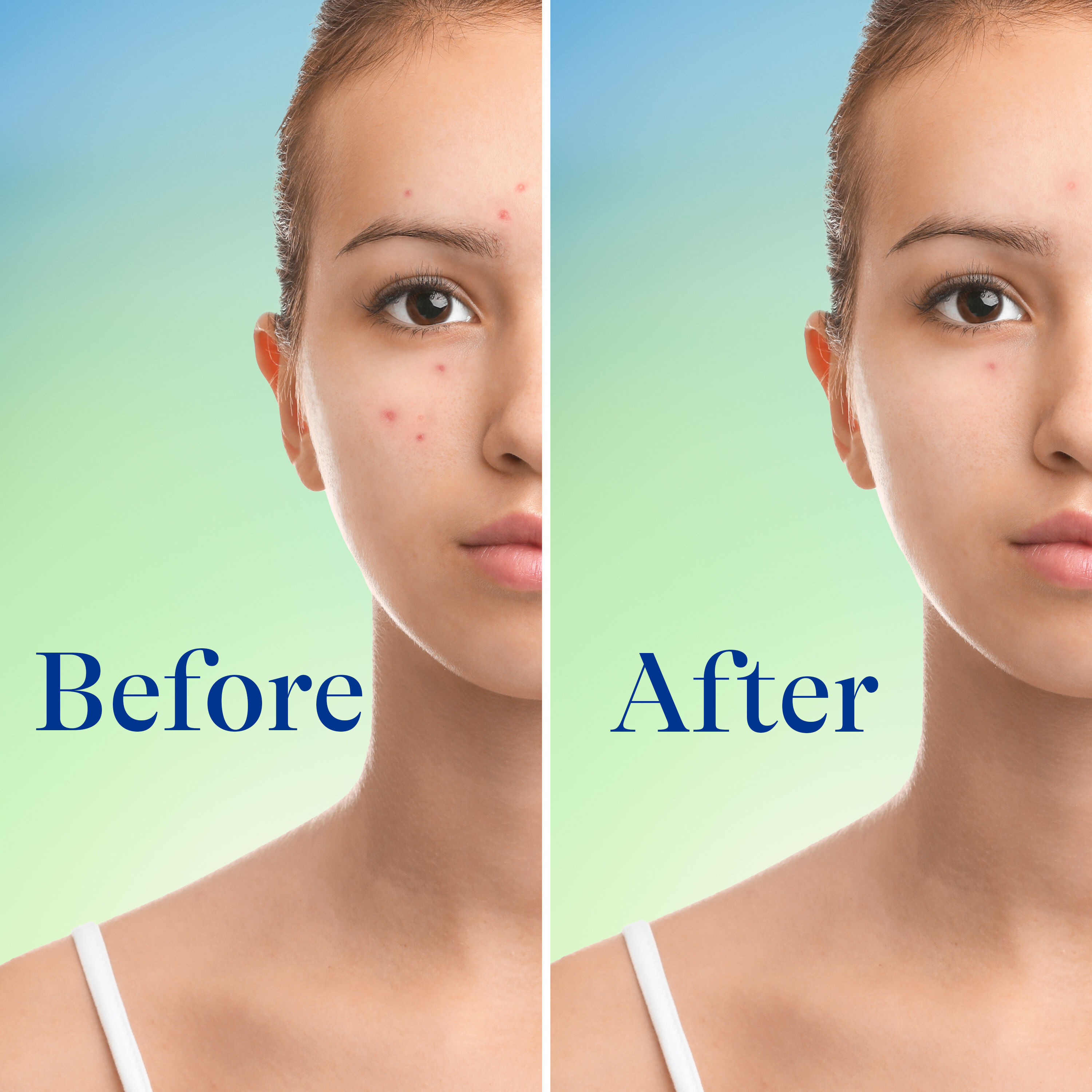 10% Benzoyl Peroxide Maximum Strength Acne Foaming Cleanser