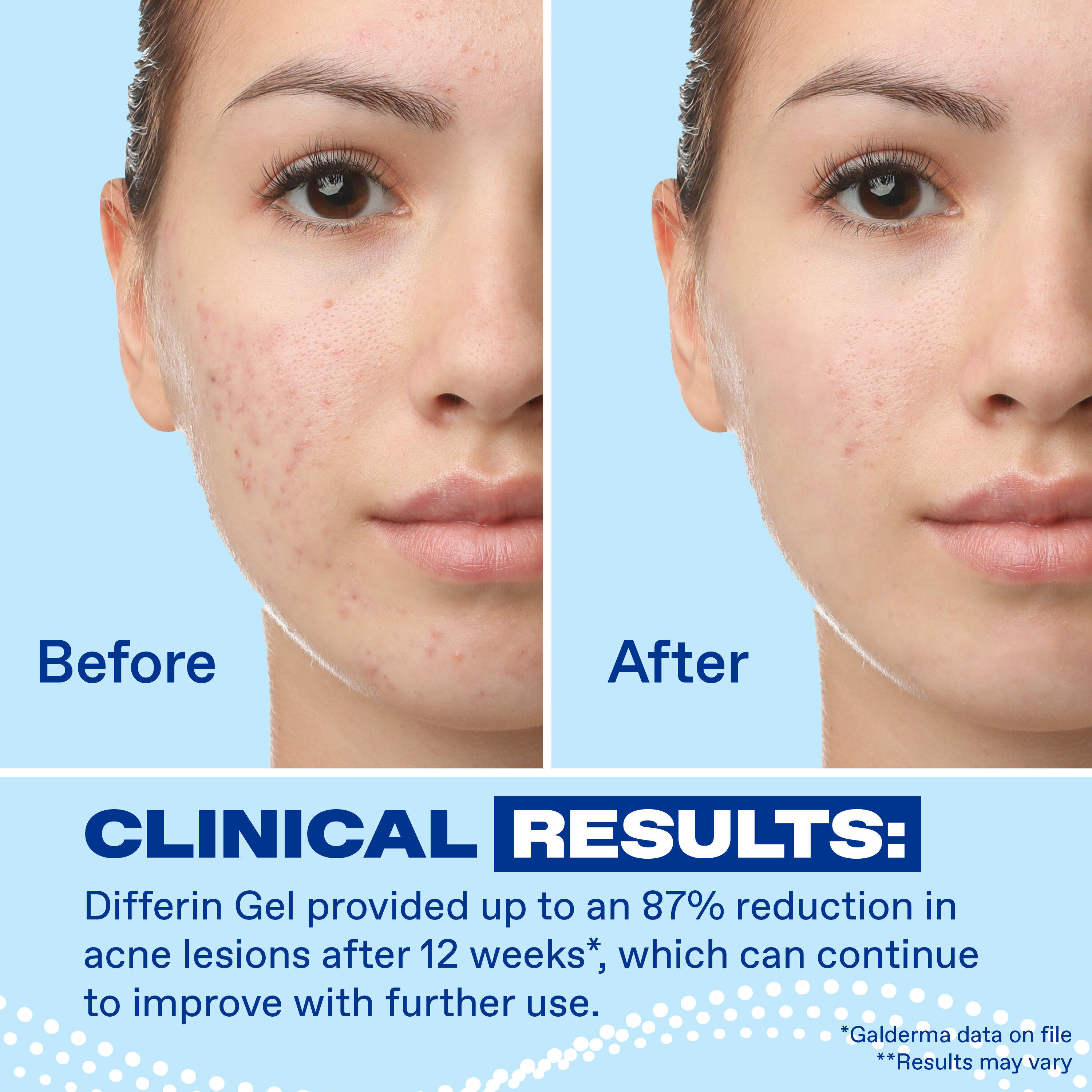 Adapalene Gel Retinoid