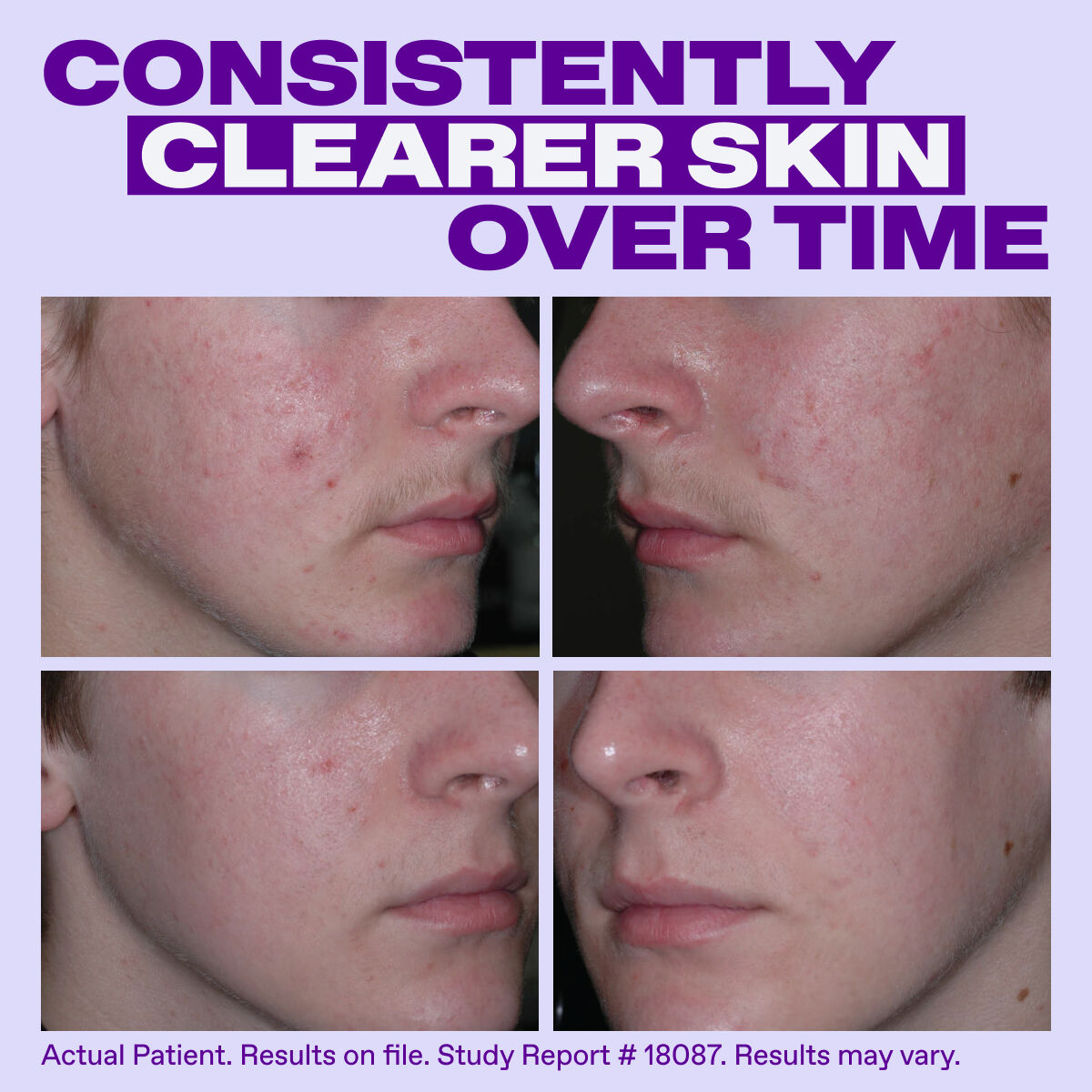 Differin Epiduo Acne Gel​