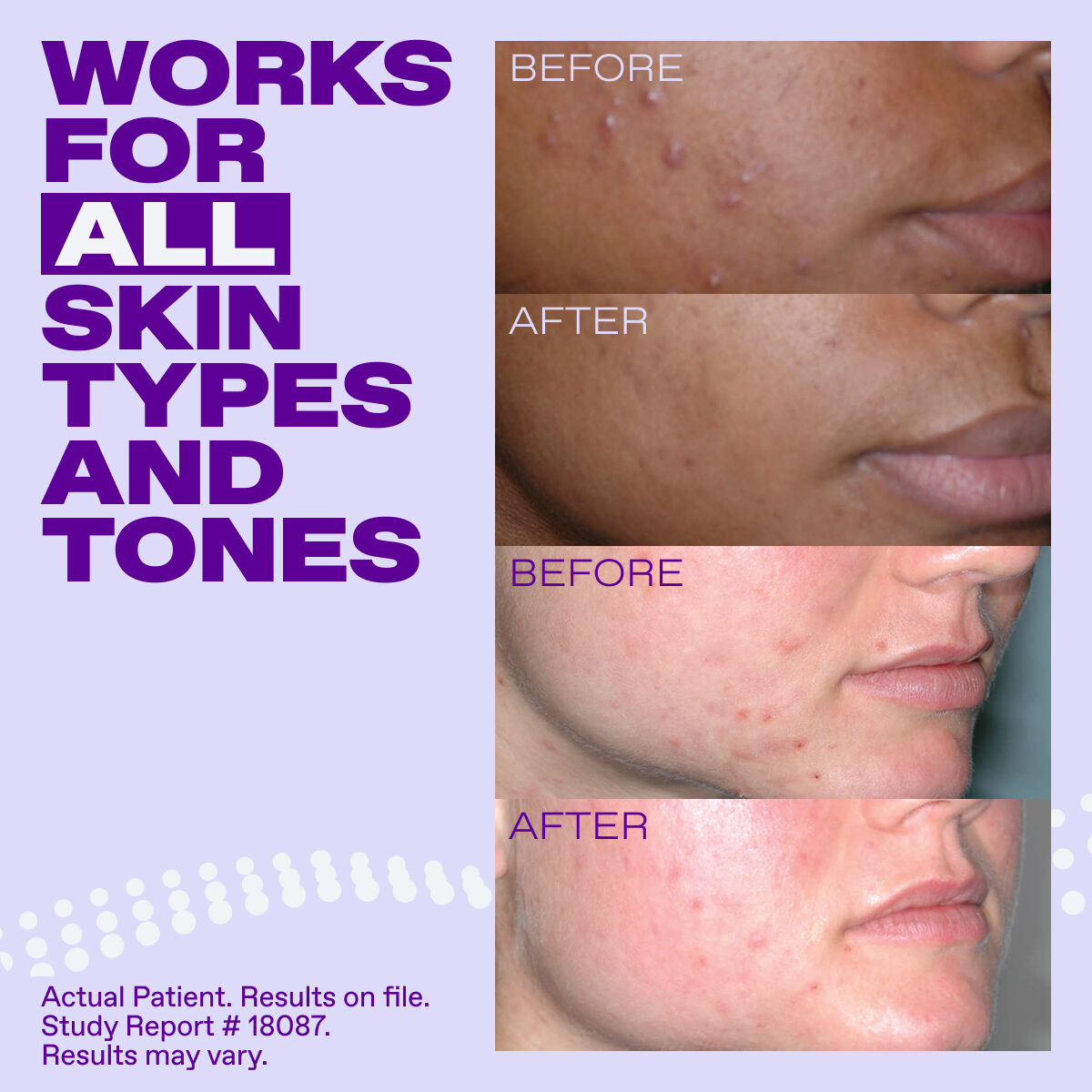 Differin Epiduo Acne Gel​