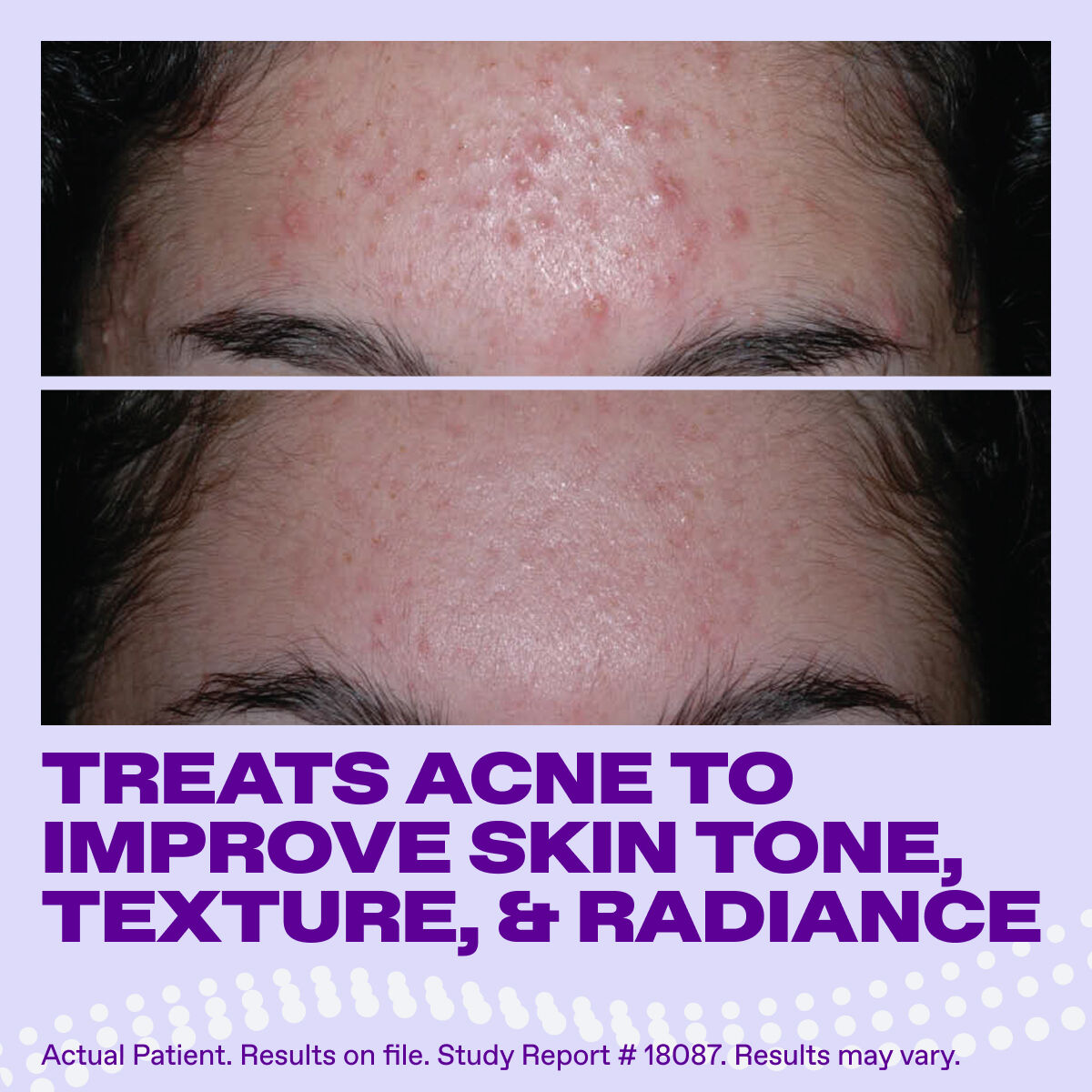 Differin Epiduo Acne Gel​