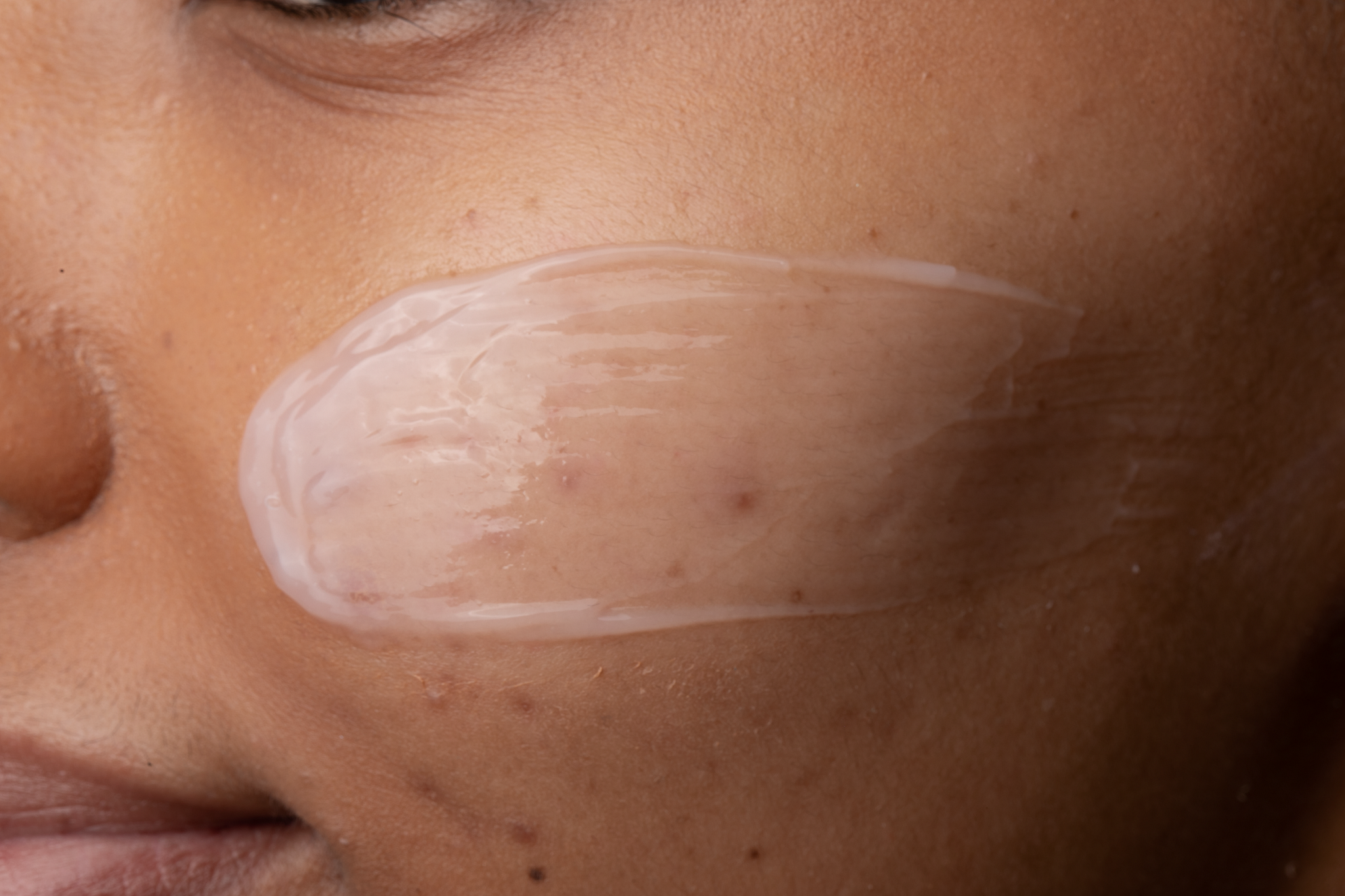 DIFFERIN VS. OTHER ACNE TREATMENTS