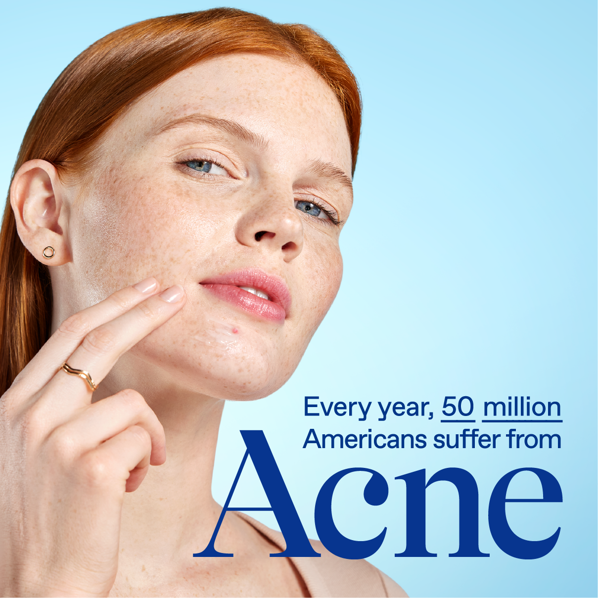 50 million Americans suffer from acne annually