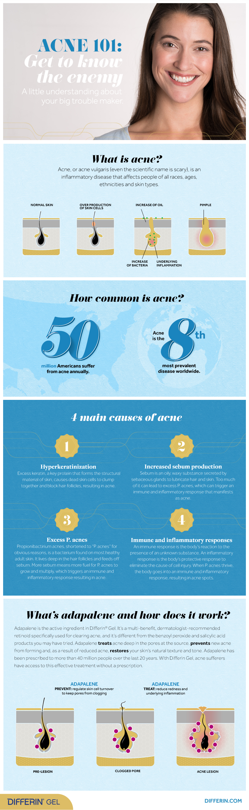 Acne 101 infographic
