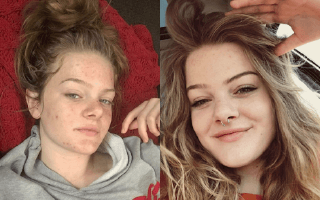 Differin real before and after acne treatment results - Example 0