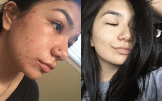 Differin real before and after acne treatment results - Example 1