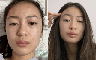 Differin real before and after acne treatment results - Example 3