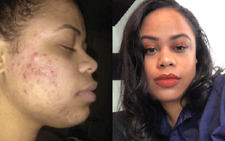 Differin real before and after acne treatment results - Example 4